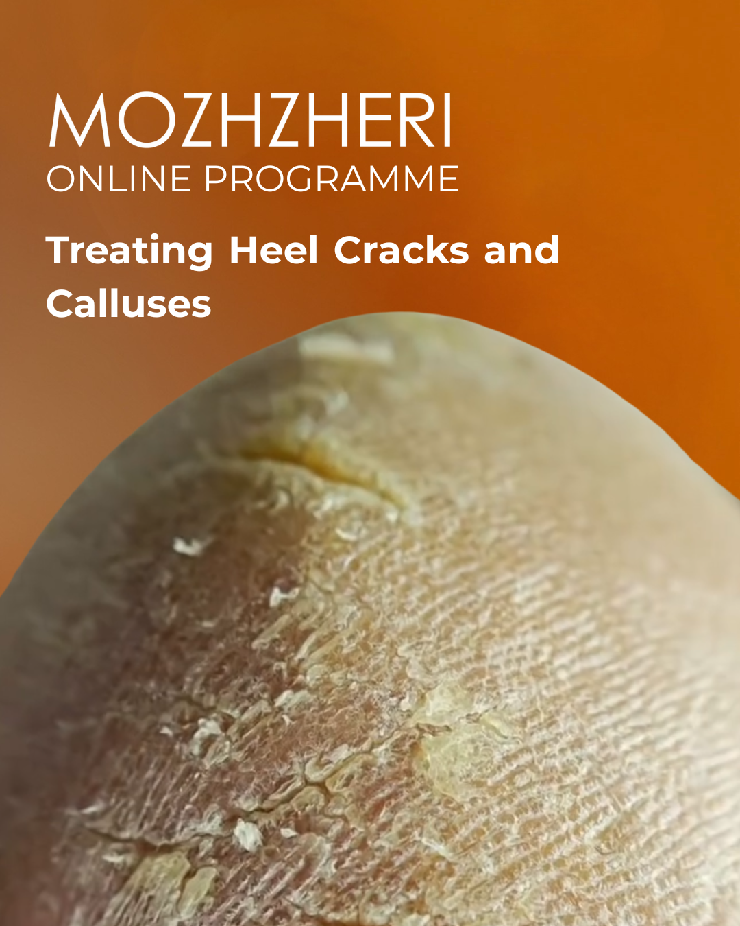 MOZHZHERI E-File: Treating Heel Cracks and Calluses Online