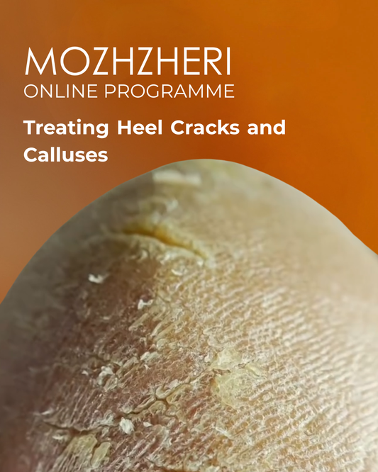 MOZHZHERI E-File: Treating Heel Cracks and Calluses Online